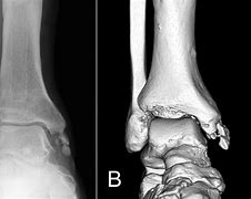 Image result for Area Distal to Lateral Malleolus