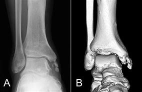 Image result for Verticam Medial Malleolus Fracture