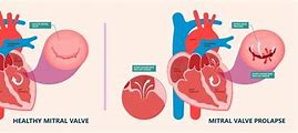 Image result for Acute Endocarditis