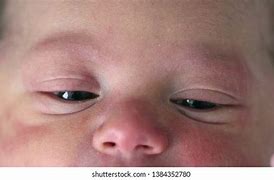 Image result for Baby Rash around Eyes