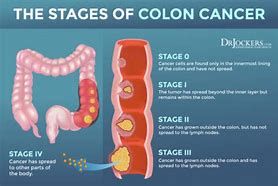 Image result for Colon Cancer Symptoms in Men Signs