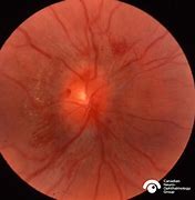 Image result for Papilledema