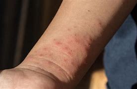 Image result for Bed Bug Bites Row