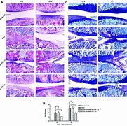 Image result for Inflammed Synovial Tissue