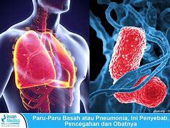 Image result for Penyakit Paru-Paru