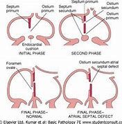 Image result for Septum Secundum