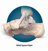 Image result for Deltoid Ligament Repair