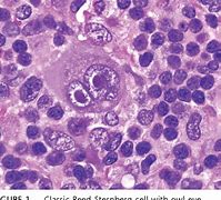 Image result for Mixed Cellularity Hodgkin Lymphoma