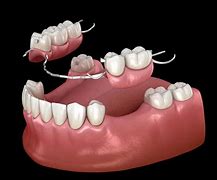 Image result for Partial Plate Dentures