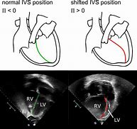 Image result for Atrioventricular Septum