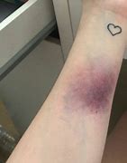 Image result for Blood Bruise Aesthetic