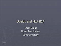 Image result for HLA Gene Uveitis