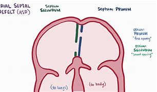 Image result for Septum Secundum