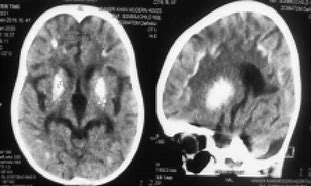 Image result for CT Brain Lentiform Nucleus