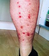 Image result for Big Bed Bug Bites