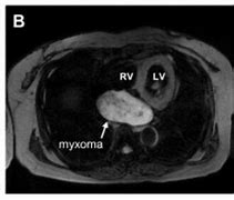 Image result for Biatrial Myxoma