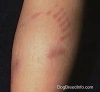 Image result for Ari Abdul Bite Marks