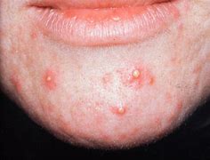 Image result for Large Acne Pustules