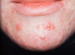 Image result for Pustules and Inflammatory Acne