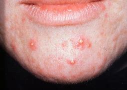 Image result for Pustules and Inflammatory Acne