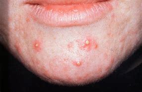 Image result for Infected Acne Pustules