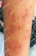 Image result for Lower Leg Pustules