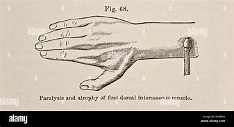 Image result for First Dorsal Interosseous Atrophy