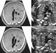 Image result for Abnormal Fetal Heart Ultrasound