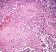 Image result for Hemangioma On Liver