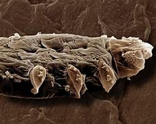 Image result for Skin Mites On Humans