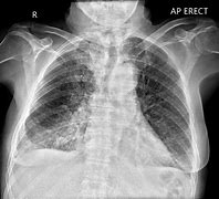 Image result for Acute Lung Oedema