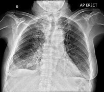 Image result for Acute Pulmonary Oedema and Fluid Overload