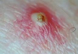 Image result for Ingrown Hair and Boils