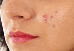 Image result for People with Pimples