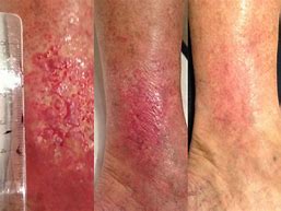 Image result for Vasculitis Leg Ulcers