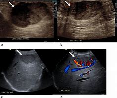 Image result for Hemangioma Ultrasound