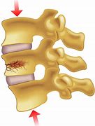 Image result for Lumbar Compression Burst Fractures