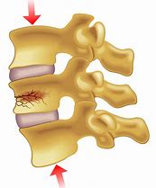 Image result for Imagees Compression Fracture of Lumbar Vertebrae