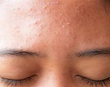 Image result for Benign Skin Bumps