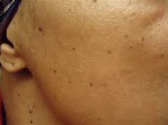 Image result for Black Spots On Skin Means