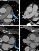 Image result for Cardiac CT Left Atrial Appendage Thrombus