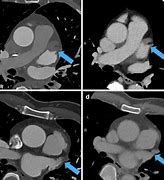 Image result for Atrleft Atrail Appendage Thrombus