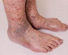 Image result for Skin Darkening Legs