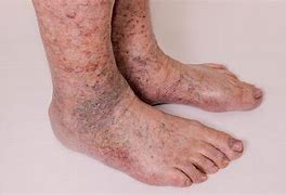 Image result for Thickened Skin On Lower Legs