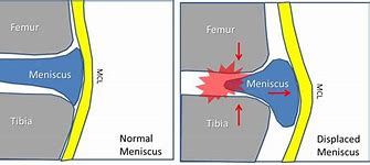 Image result for Right Knee Meniscus