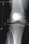 Image result for Patellofemoral Joint Space Narrowing