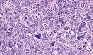 Image result for Medulloblastoma in Child