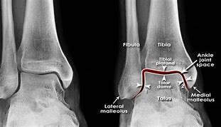 Image result for Area Distal to Lateral Malleolus