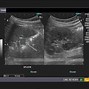 Image result for Spleen Infarction Ultrasound