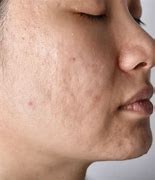 Image result for Acne Pit Scar